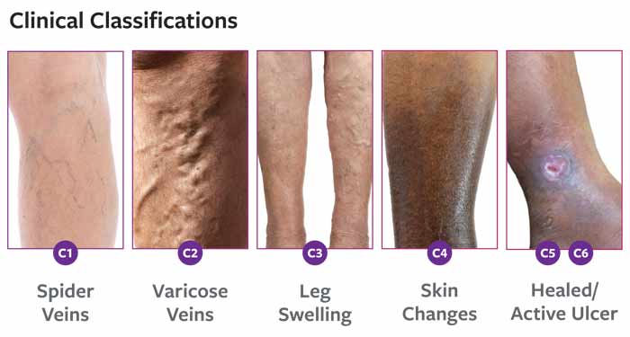 Common signs and symptoms in the lower legs