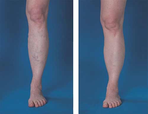 Endovenous leg treatment