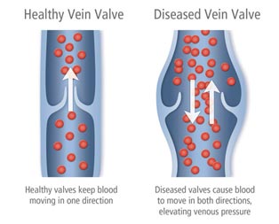 Healty Vein Valve and Diseased Vein Valve