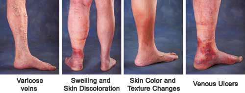 Circulations problems in the  legs