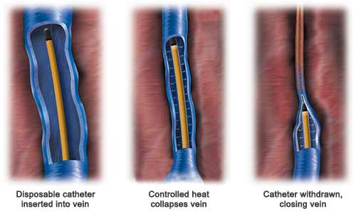 Endovenous Treatment