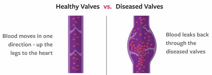Drawing showing healthy and diseased valves